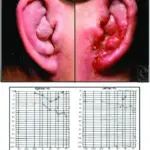 Otitis Externa