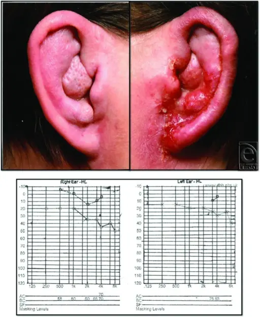 Otitis Externa