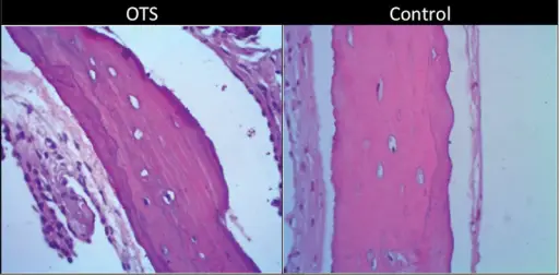 Otosclerosis