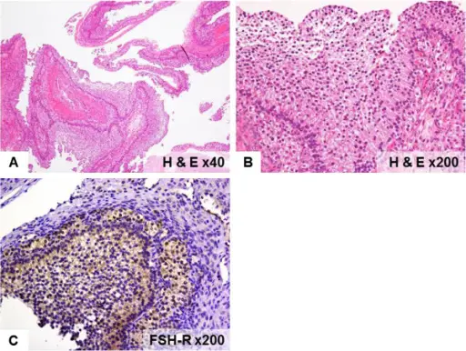 Ovarian Follicle Cysts