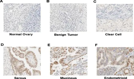 Ovarian Tumors