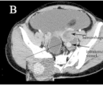 Ovarian Yolk Sac Tumor