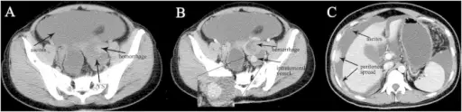 Ovarian Yolk Sac Tumor