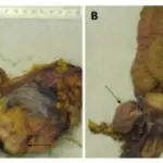 Ovary Pathology