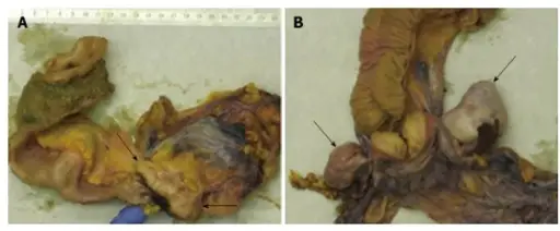 Ovary Pathology