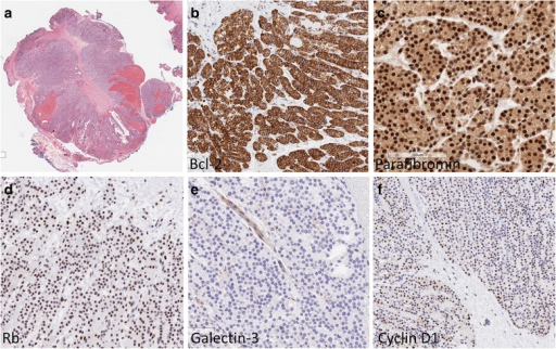 PARATHYROID GLAND PATHOLOGY