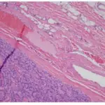 PARATHYROID GLAND PATHOLOGY