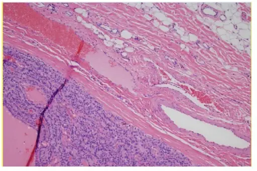 PARATHYROID GLAND PATHOLOGY