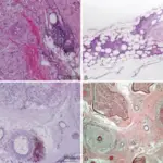 PERIPHERAL NERVOUS SYSTEM PATHOLOGY