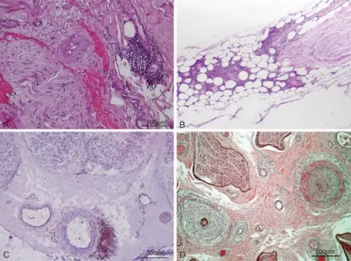 PERIPHERAL NERVOUS SYSTEM PATHOLOGY