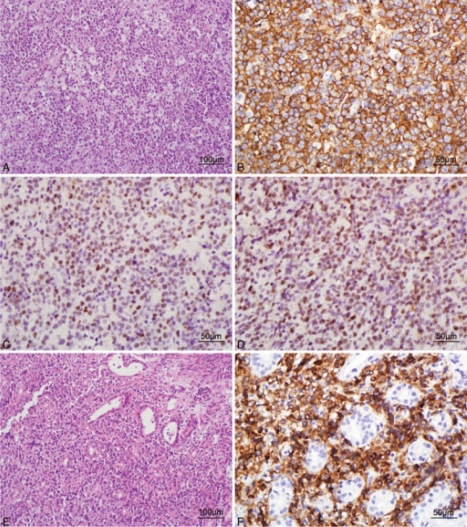 PINEAL GLAND PATHOLOGY