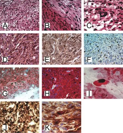 PINEAL GLAND PATHOLOGY