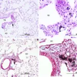 PULMONARY PATHOLOGY