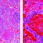 PULMONARY PATHOLOGY