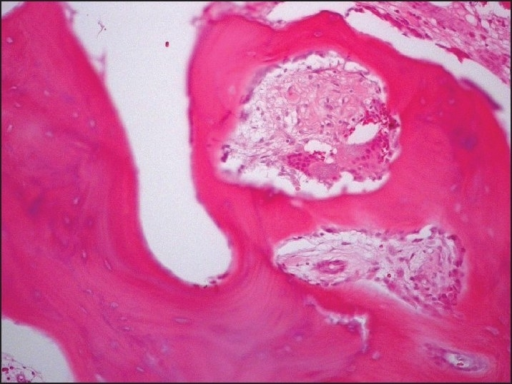 Paget Disease of the Bone
