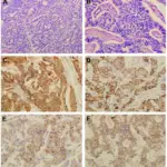 Pancreatic Carcinoid Tumor