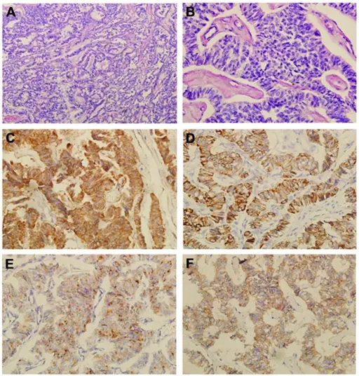 Pancreatic Carcinoid Tumor