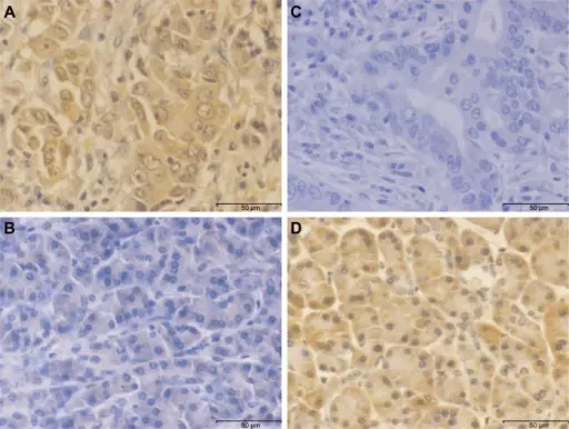 Pancreatic Carcinoma aka ductal carcinoma of the pancreas