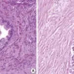 Pancreatic Intraepithelial Neoplasia (PanIN)