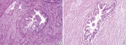 Pancreatic Intraepithelial Neoplasia (PanIN)