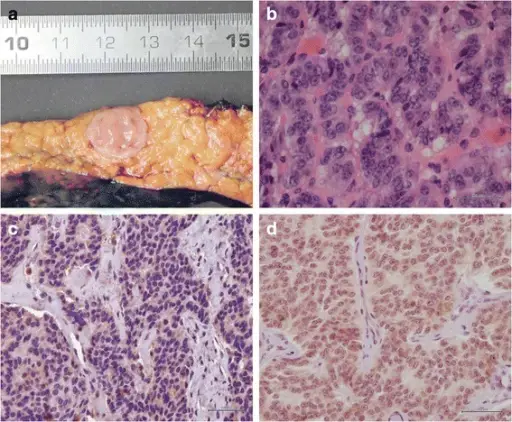 Pancreatic Neuroendocrine Tumors