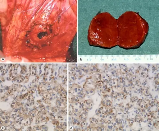 Pancreatic Polypeptide-Secreting Endocrine Tumors