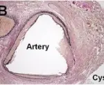 Pancreatic Pseudocysts