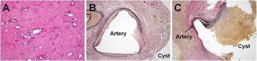 Pancreatic Pseudocysts