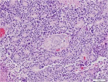 Pancreatoblastoma