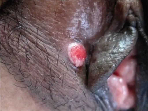 Papillary Hidradenoma of the Vulva