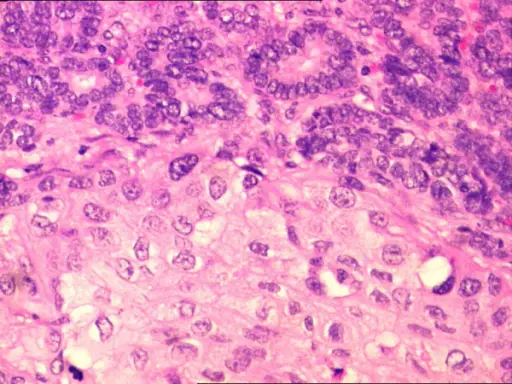 Papillary Carcinoma