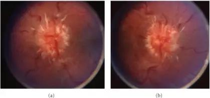 Papilledema