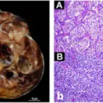 Paragangliomas