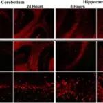 Paraneoplastic Syndromes that Affect the Central Nervous System