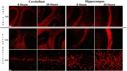 Paraneoplastic Syndromes that Affect the Central Nervous System