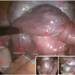 Paratubal Cysts