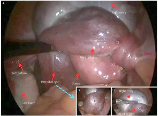 Paratubal Cysts