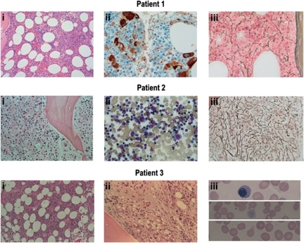 Paroxysmal Nocturnal Hemoglobinuria