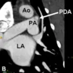 Patent Ductus Arteriosus