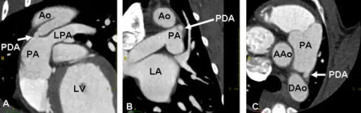 Patent Ductus Arteriosus