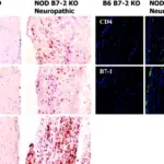 Patterns of Peripheral Neuropathies