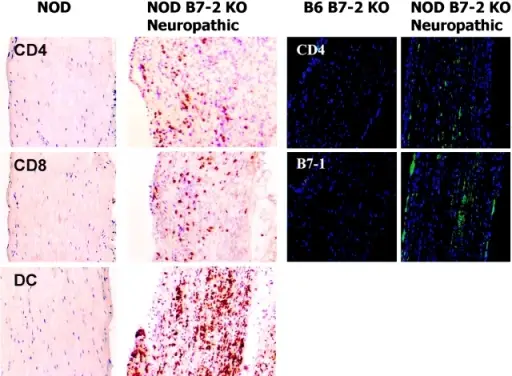 Patterns of Peripheral Neuropathies