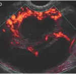 Pelvic Inflammatory Disease