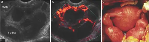 Pelvic Inflammatory Disease