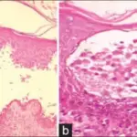 Pemphigus Vulgaris