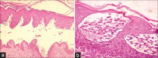 Pemphigus Vulgaris