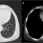 Pericardial Disease