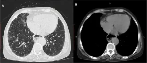 Pericardial Disease