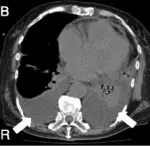 Pericardial Effusion