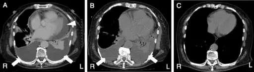 Pericardial Effusion